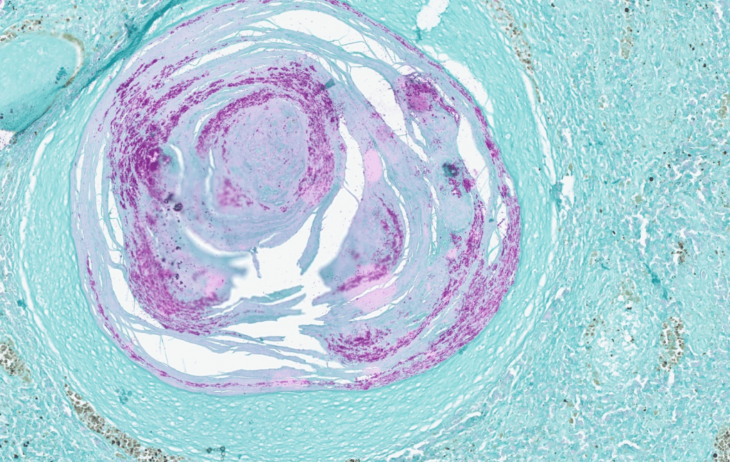 mycobacteria granuloma acid fast stain fish tuberculosis